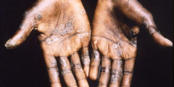 1997
Brian W.J. Mahy, BSc, MA, PhD, ScD, DSc

This image was created during a investigation into an outbreak of monkeypox, which took place in the Democratic Republic of Congo (DRC), 1996 to 1997, formerly Zaire, and depicts the palms of a monkeypox case patient from Lodja, a city located within the Katako-Kombe Health Zone, of the DRC. Note how similar this maculopapular rash appears to be when compared to the rash of smallpox, also a Orthopoxvirus.

In 1996, 71 suspected human monkeypox cases were reported from the Katako-Kombe Health Zone, Kasai Oriental, DRC. These initial reports suggested predominant person-to-person transmission and prolonged chains of transmission. Two cases were confirmed by monkeypox virus isolation from lesion material. In February 1997, an investigation was initiated. Our report describes epidemiologic observations and laboratory results supporting the conclusion that repeated animal reintroduction of monkeypox virus is needed to sustain the disease in the local human population. For more extensive details, as well as citations, see the link below.PHIL images 12745 through 12784 depict a full slide presentation telling the story of this investigation.
