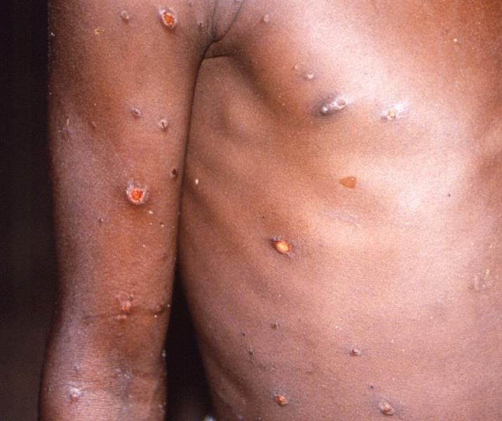 monkeypox_on_arm_and_chest-cdc.jpg
 Monkeypox lesions on arm and chest
CDC / Brian W. J. Mahy