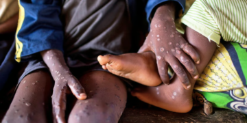 WHO declares mpox a global public health emergency for second time in two years. photograph: Panos